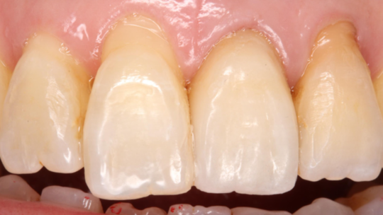 審美歯科治療 - エース歯科（北群馬郡吉岡町）