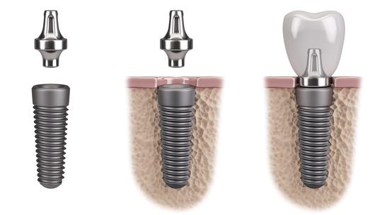 インプラント治療 - エース歯科（北群馬郡吉岡町）