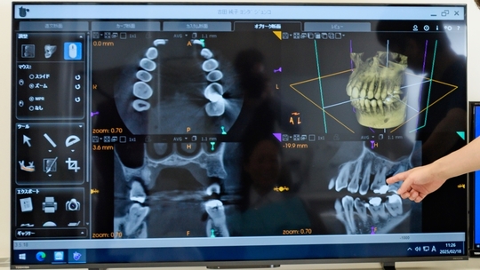インプラント治療 - エース歯科（北群馬郡吉岡町）