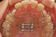 上顎拡大装置