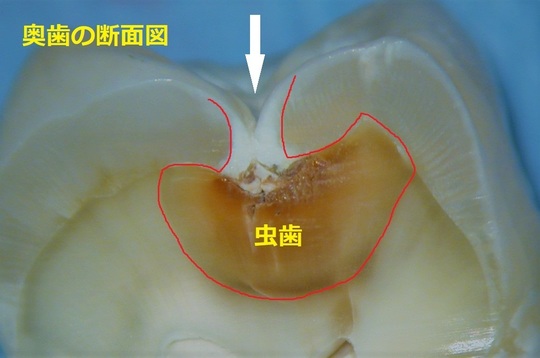 歯周病の治療 エース歯科 北群馬郡